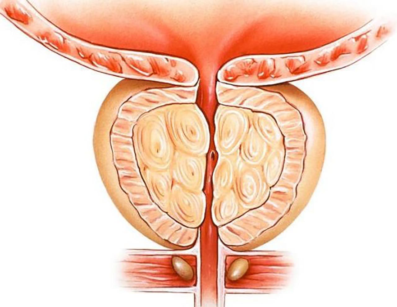 Nguyên nhân dẫn đến ung thư tuyến tiền liệt