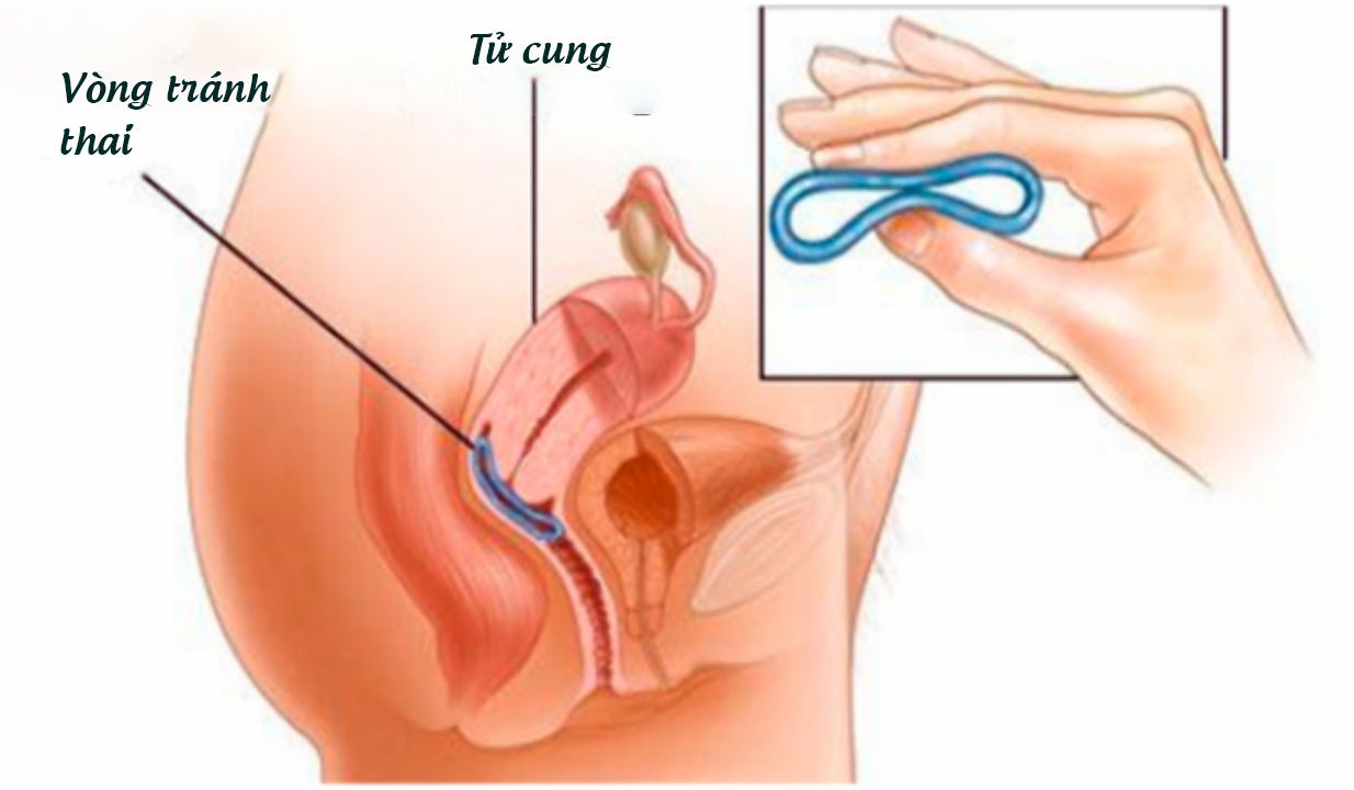 Khi nào phụ nữ có thể đặt lại vòng tránh thai