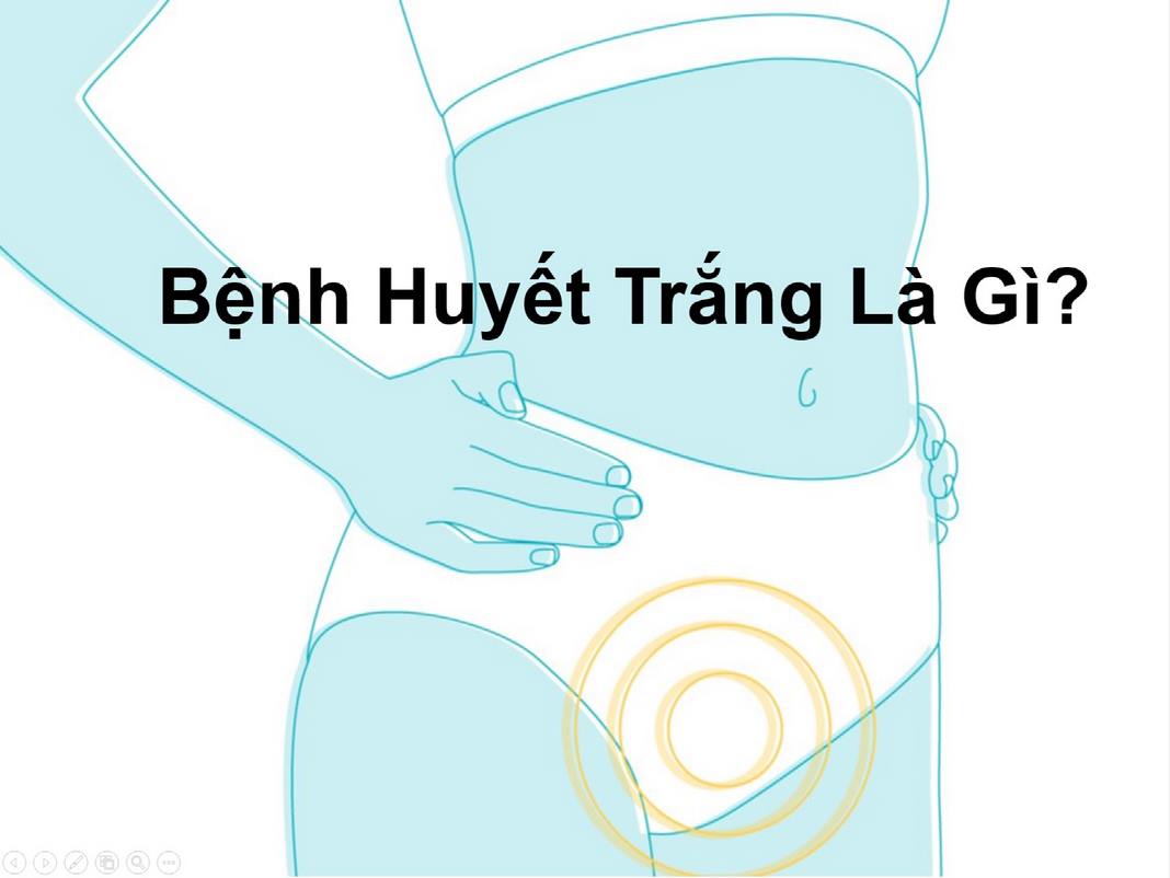 Bệnh huyết trắng là gì? Biện pháp điều trị ra sao?