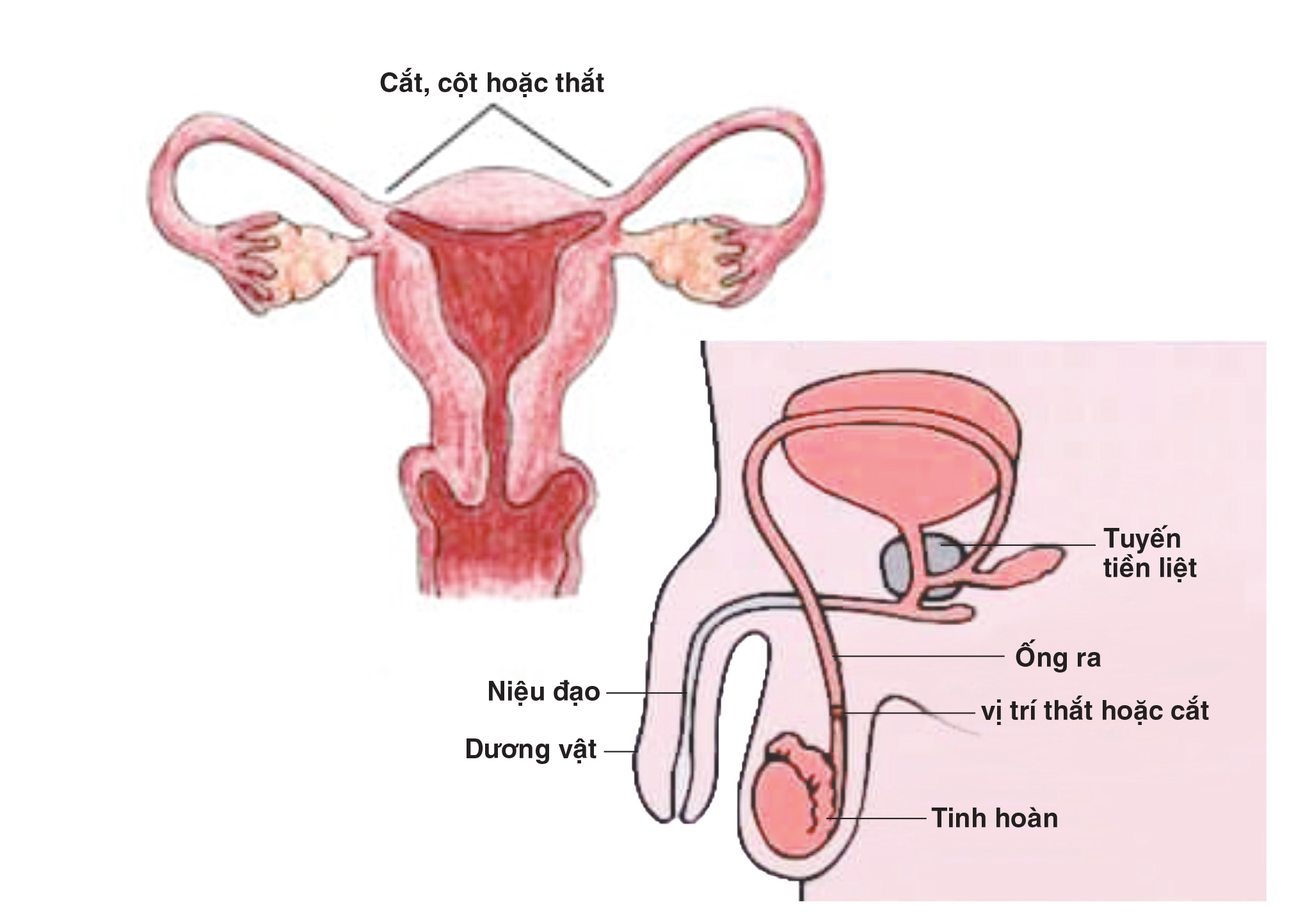 Triệt sản tinh trùng ở đàn ông